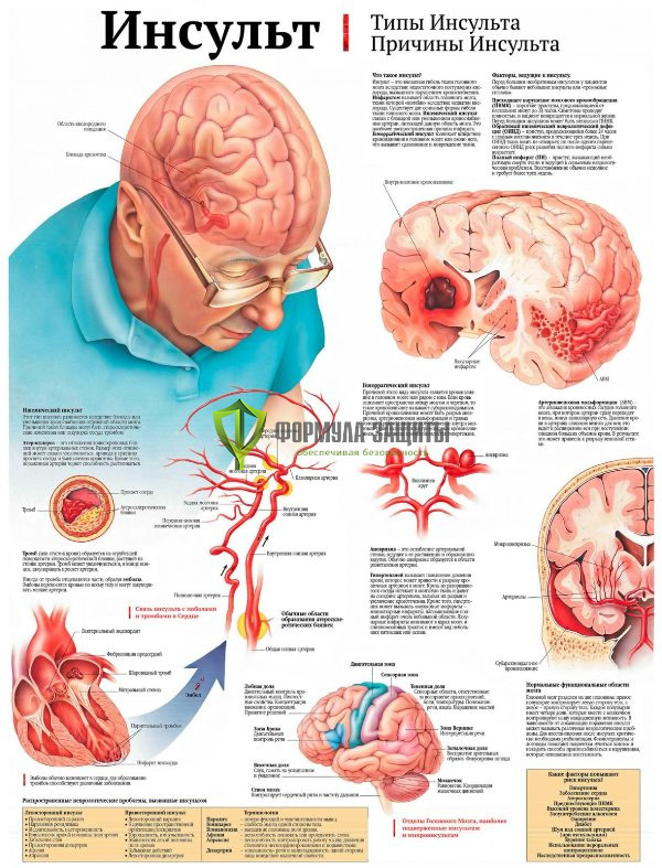 Плакат «Инсульт» от интернет-магазина Формула Защиты