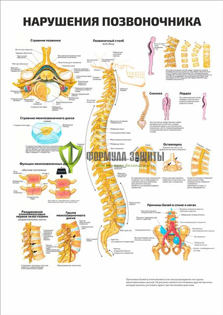 Плакат «Нарушения позвоночника» от интернет-магазина Формула Защиты